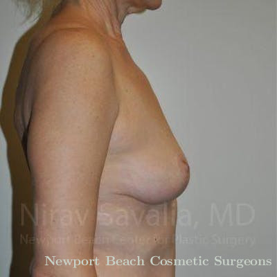 Breast Explantation En Bloc Capsulectomy Before & After Gallery - Patient 1655472 - After