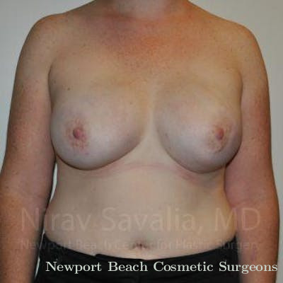Breast Lift without Implants Before & After Gallery - Patient 1655468 - After