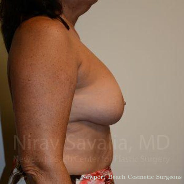 Mastectomy Reconstruction Before & After Gallery - Patient 1655471 - Before