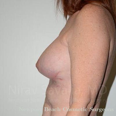 Chin Implants Before & After Gallery - Patient 1655467 - After