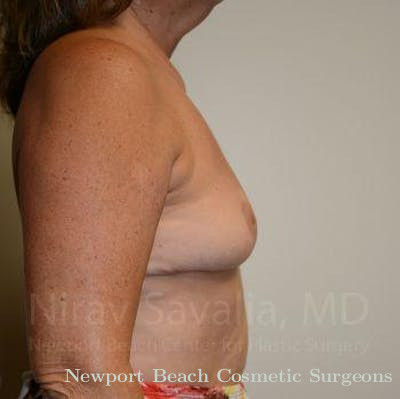 Breast Lift with Implants Before & After Gallery - Patient 1655471 - After