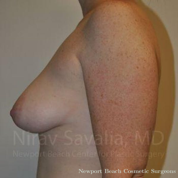 Breast Lift with Implants Before & After Gallery - Patient 1655468 - Before
