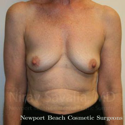 Chin Implants Before & After Gallery - Patient 1655475 - Before