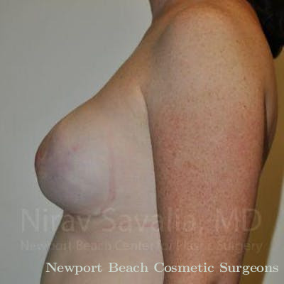 Breast Explantation En Bloc Capsulectomy Before & After Gallery - Patient 1655468 - After