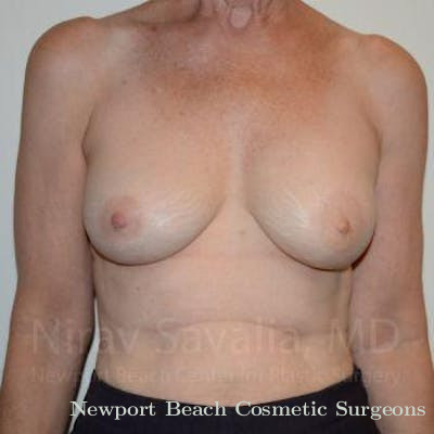 Breast Explantation En Bloc Capsulectomy Before & After Gallery - Patient 1655475 - After
