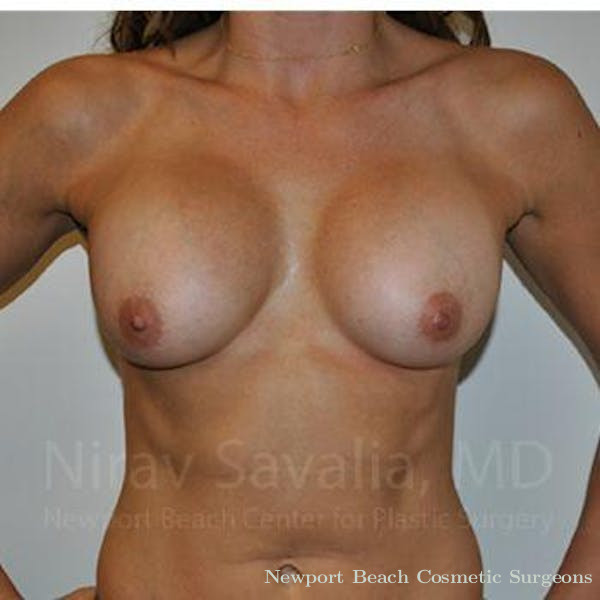 Mastectomy Reconstruction Revision Before & After Gallery - Patient 1655470 - Before
