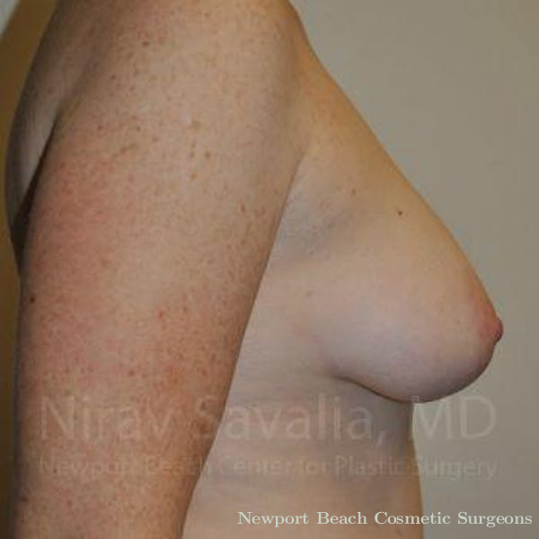 Mastectomy Reconstruction Revision Before & After Gallery - Patient 1655468 - Before