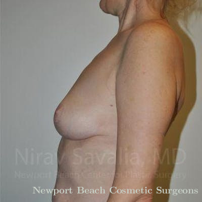 Oncoplastic Reconstruction Before & After Gallery - Patient 1655472 - After