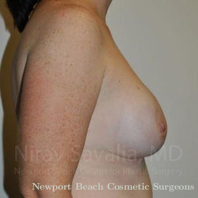 Liposuction Before & After Gallery - Patient 1655468 - After