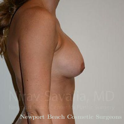 Chin Implants Before & After Gallery - Patient 1655470 - After