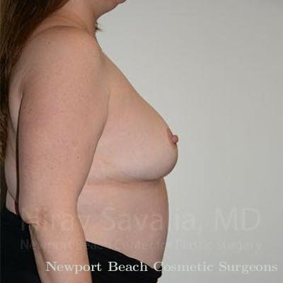 Body Contouring after Weight Loss Before & After Gallery - Patient 1655476 - After