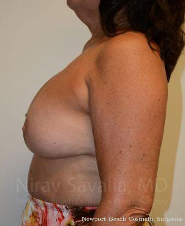 Breast Explantation En Bloc Capsulectomy Before & After Gallery - Patient 1655471 - Before
