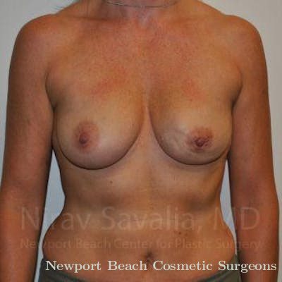 Breast Lift with Implants Before & After Gallery - Patient 1655474 - Before