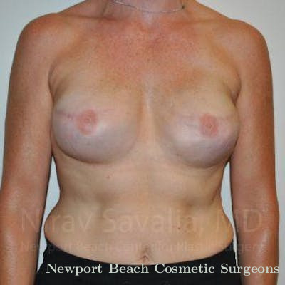 Breast Explantation En Bloc Capsulectomy Before & After Gallery - Patient 1655474 - After