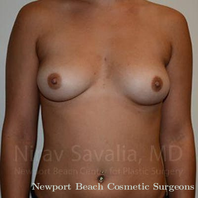 Breast Explantation En Bloc Capsulectomy Before & After Gallery - Patient 1655477 - Before