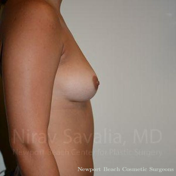 Mastectomy Reconstruction Revision Before & After Gallery - Patient 1655477 - Before