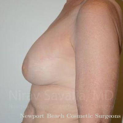 Breast Implant Revision Before & After Gallery - Patient 1655475 - After