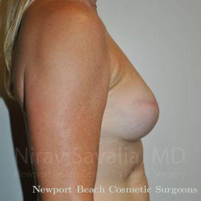 Mastectomy Reconstruction Before & After Gallery - Patient 1655474 - After
