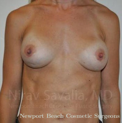 Breast Lift without Implants Before & After Gallery - Patient 1655478 - Before