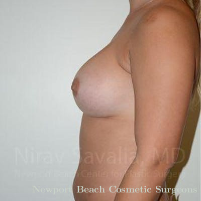 Breast Implant Revision Before & After Gallery - Patient 1655477 - After