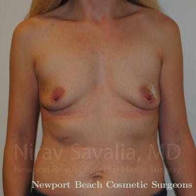 Mastectomy Reconstruction Before & After Gallery - Patient 1655479 - Before