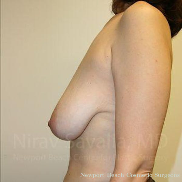 Breast Lift without Implants Before & After Gallery - Patient 1655480 - Before
