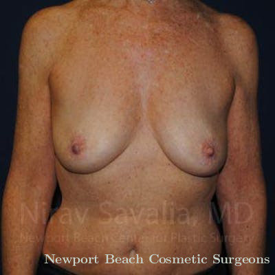 Facelift Before & After Gallery - Patient 1655481 - Before