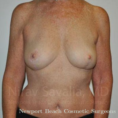 Male Breast Reduction Before & After Gallery - Patient 1655481 - After