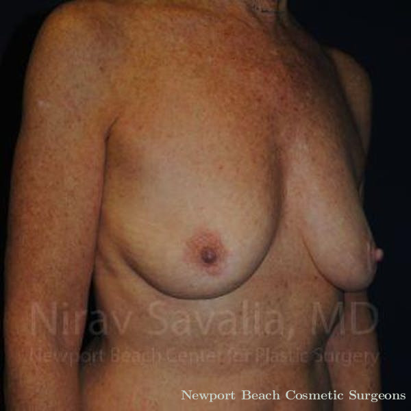 Mastectomy Reconstruction Revision Before & After Gallery - Patient 1655481 - Before