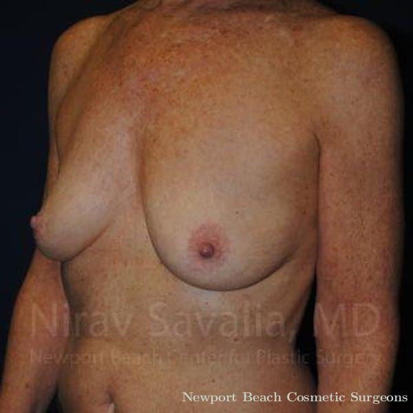 Breast Explantation En Bloc Capsulectomy Before & After Gallery - Patient 1655481 - Before