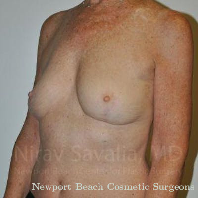 Breast Implant Revision Before & After Gallery - Patient 1655481 - After
