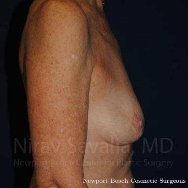 Oncoplastic Reconstruction Before & After Gallery - Patient 1655481 - Before
