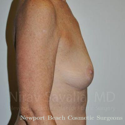 Breast Augmentation Before & After Gallery - Patient 1655481 - After
