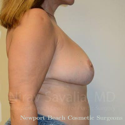 Mastectomy Reconstruction Before & After Gallery - Patient 1655482 - After