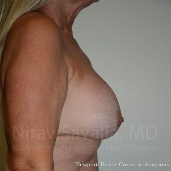 Arm Lift Before & After Gallery - Patient 1655483 - Before