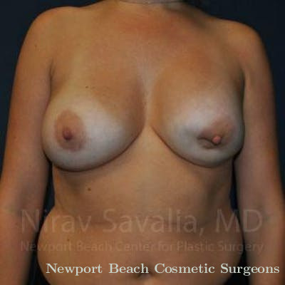 Mastectomy Reconstruction Revision Before & After Gallery - Patient 1655486 - Before