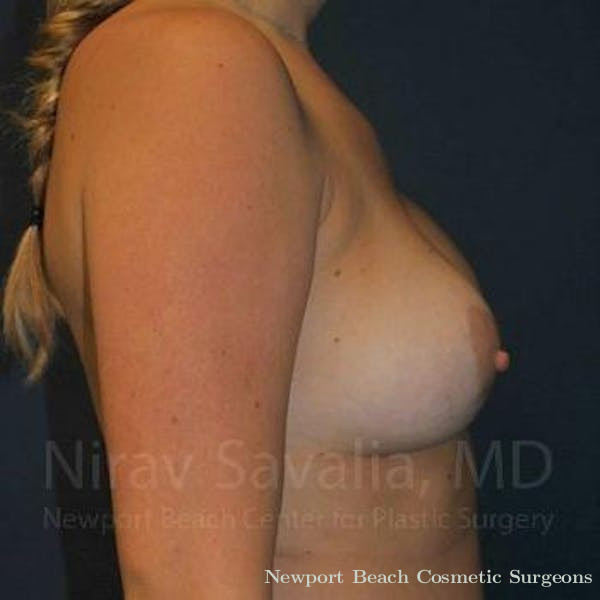 Facelift Before & After Gallery - Patient 1655486 - Before