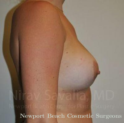 Breast Lift with Implants Before & After Gallery - Patient 1655486 - After