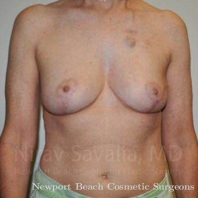 Breast Explantation En Bloc Capsulectomy Before & After Gallery - Patient 1655487 - After