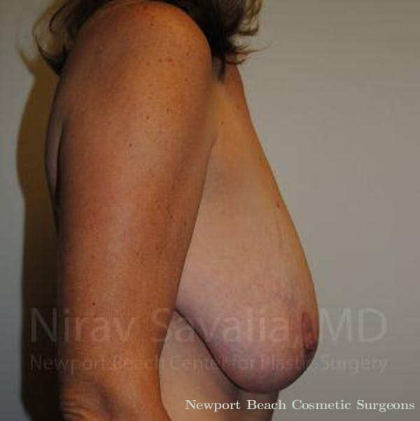 Mastectomy Reconstruction Revision Before & After Gallery - Patient 1655489 - Before
