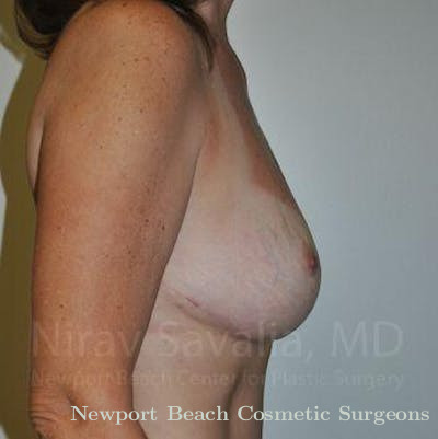 Mastectomy Reconstruction Revision Before & After Gallery - Patient 1655489 - After