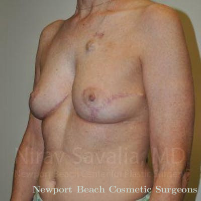 Fat Grafting to Face Before & After Gallery - Patient 1655487 - After