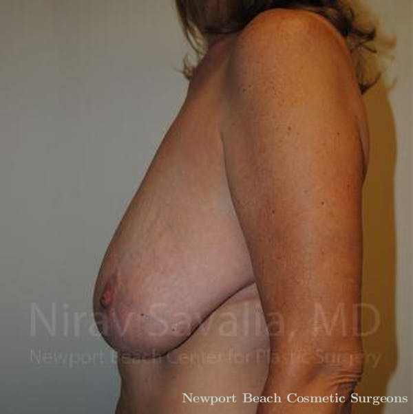 Oncoplastic Reconstruction Before & After Gallery - Patient 1655489 - Before