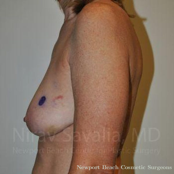 Mastectomy Reconstruction Before & After Gallery - Patient 1655487 - Before