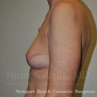 Breast Implant Revision Before & After Gallery - Patient 1655487 - After