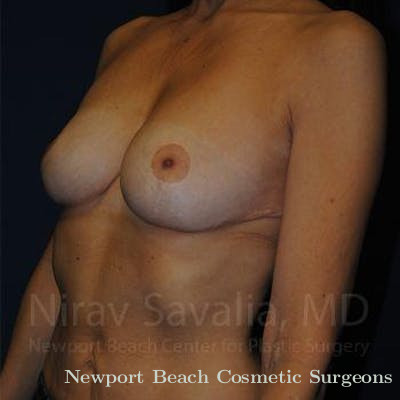 Breast Explantation En Bloc Capsulectomy Before & After Gallery - Patient 1655488 - After