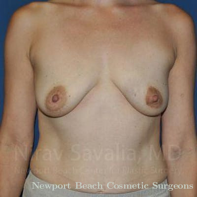 Breast Explantation En Bloc Capsulectomy Before & After Gallery - Patient 1655492 - Before