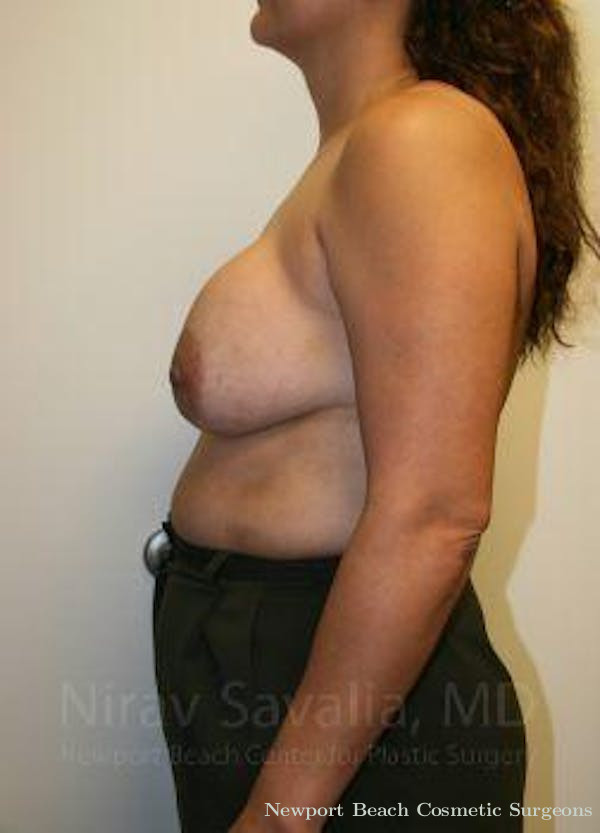 Breast Reduction Before & After Gallery - Patient 1655490 - Before