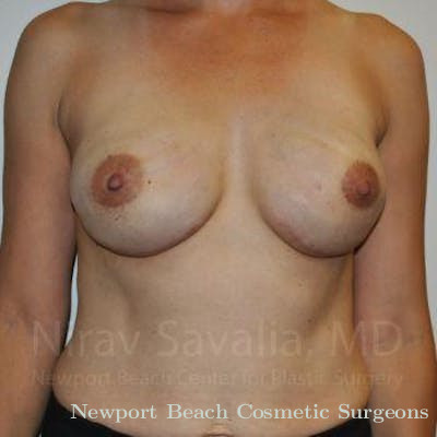Breast Explantation En Bloc Capsulectomy Before & After Gallery - Patient 1655492 - After