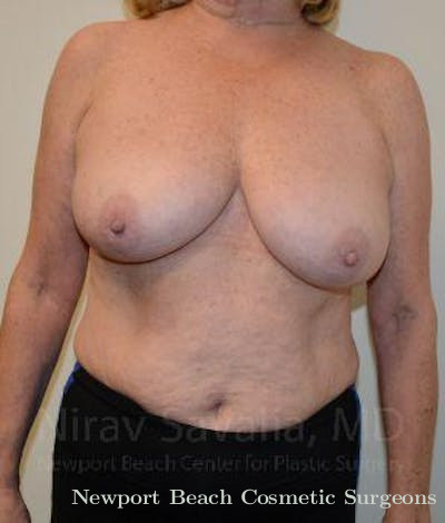 Fat Grafting to Face Before & After Gallery - Patient 1655496 - Before